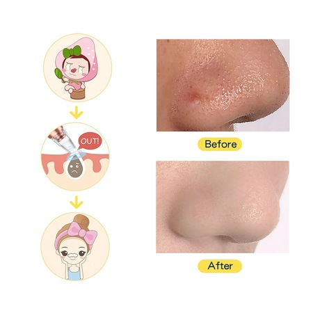 Aparat Indepartat Puncte Negre, Cu Vacuum, 3 Nivele Ajustabile, 6 Capete, Curatare si Ingrijire Faciala, Puncte de Grasime, Acnee, Incarcare USB, Alb